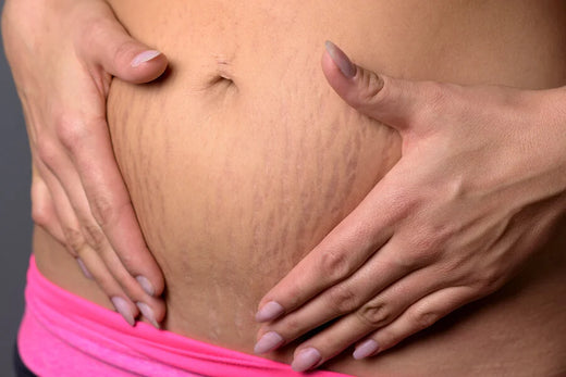 Prevention and Treatment of Stretch Marks During and After Pregnancy
